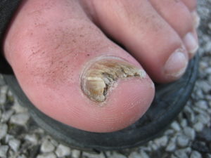 fungal big toe nail infection