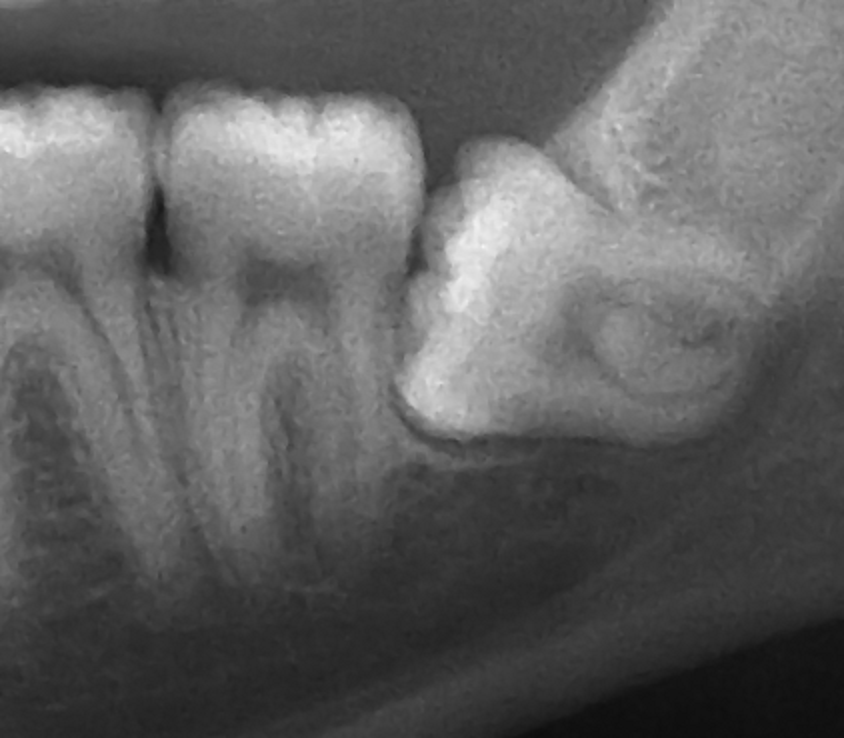 x ray of horizontal impacted wisdom tooth