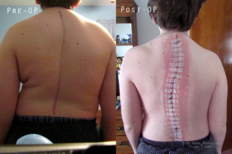 before and after scoliosis surgery