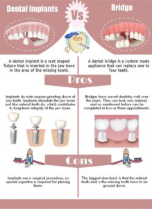 dental implant vs bridge pros and cons