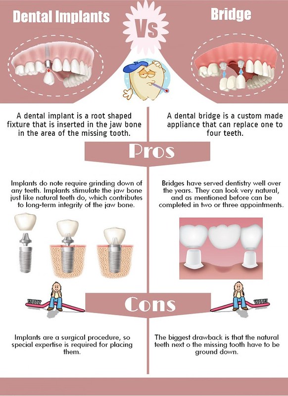 poster of dental implant pros and cons
