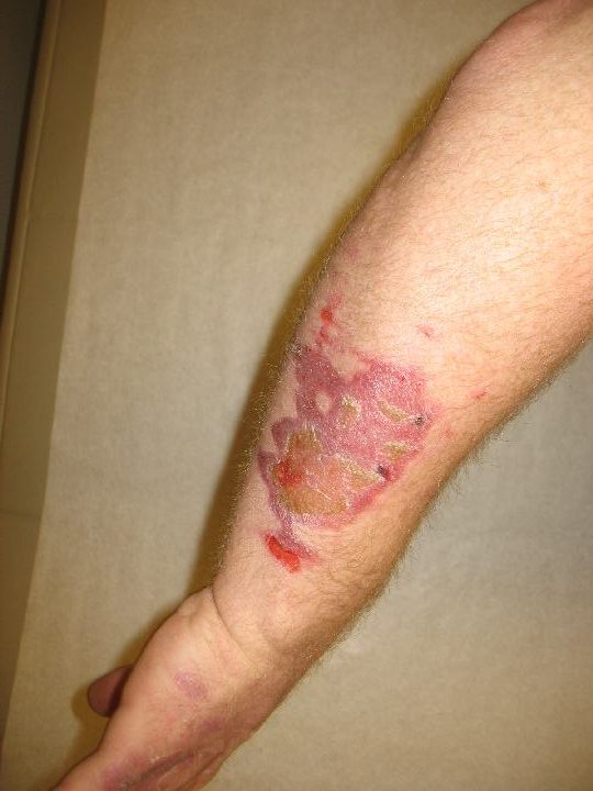 second degree burn on forearm